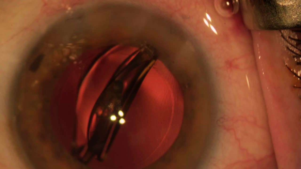 proceso de implantación de lentes oculares. imágenes macro de los ojos durante la cirugía ocular. cirugía oftalmológica.