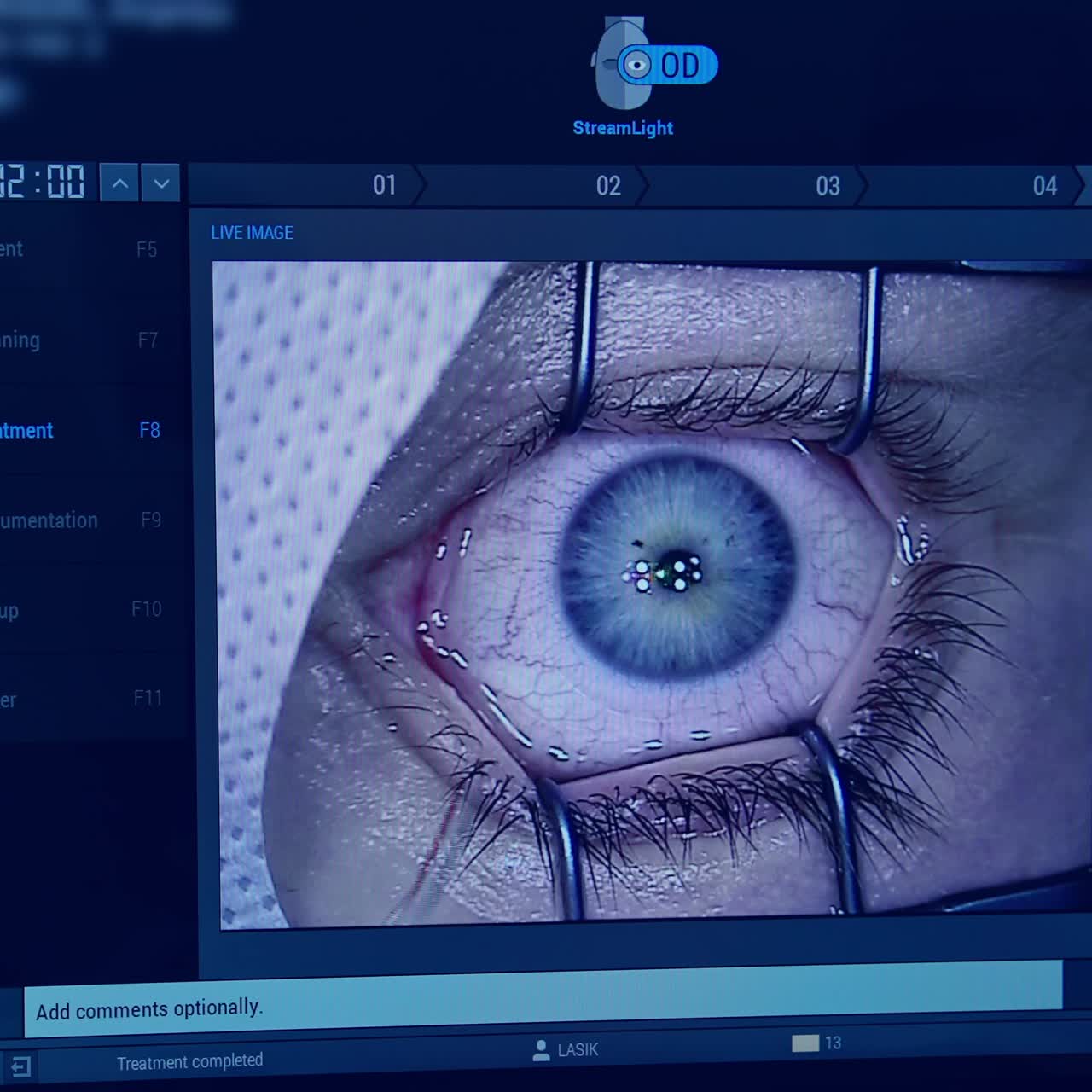 Ophthalmologist operating eye of patient. Medical workers observing eye surgery through the monitor