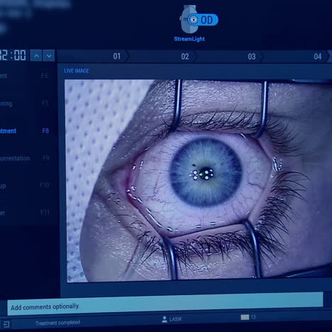 ophthalmologist operating eye of patient. medical workers observing eye surgery through the monitor