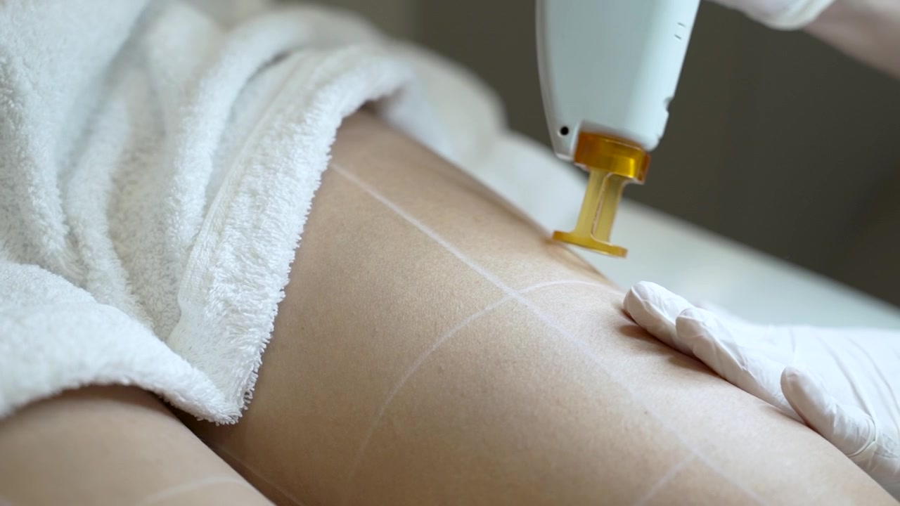 Estetista rimuove i peli dalle gambe femminili - Trattamento di epilazione laser Apotrixosi - Primo piano.