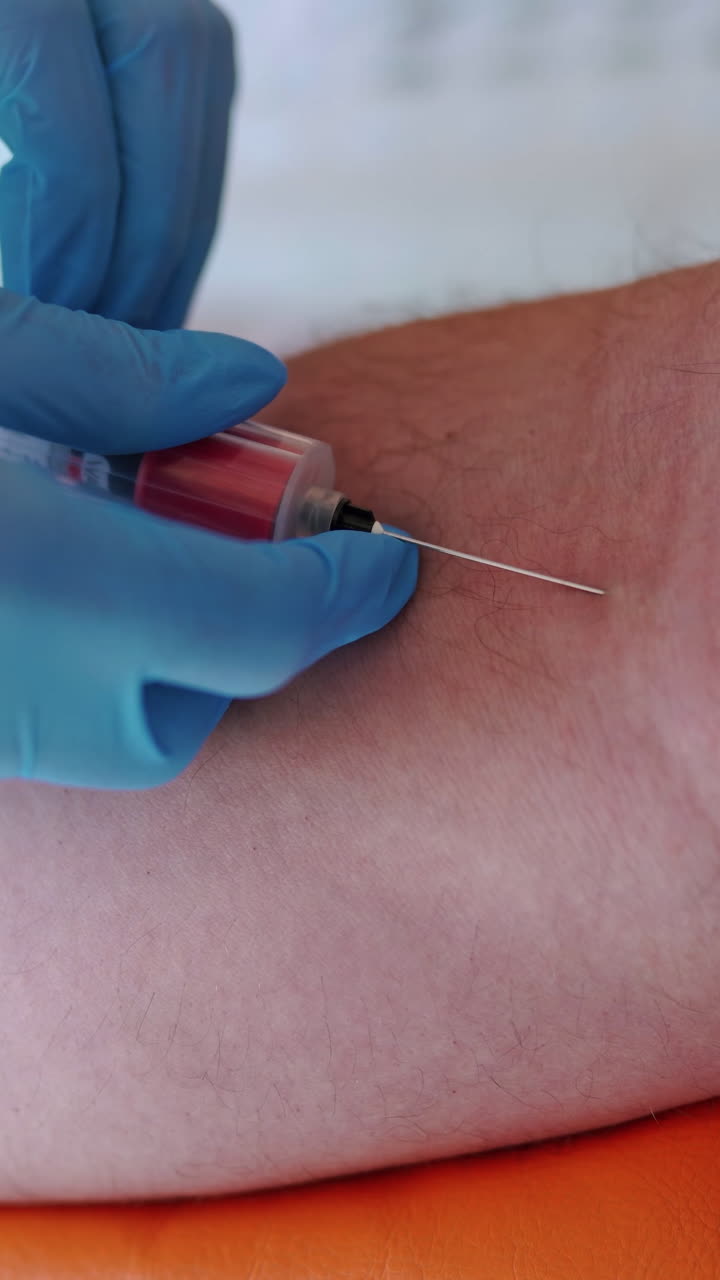 Nurse collecting blood from patient vein into syringe.The process of blood sampling from the vein for examination. Close-up. Vertical video