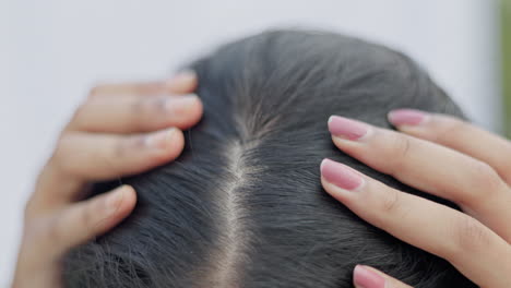 hairfall, receding hairline, closeup shot of a young lady showing her alopecia scalp in white background