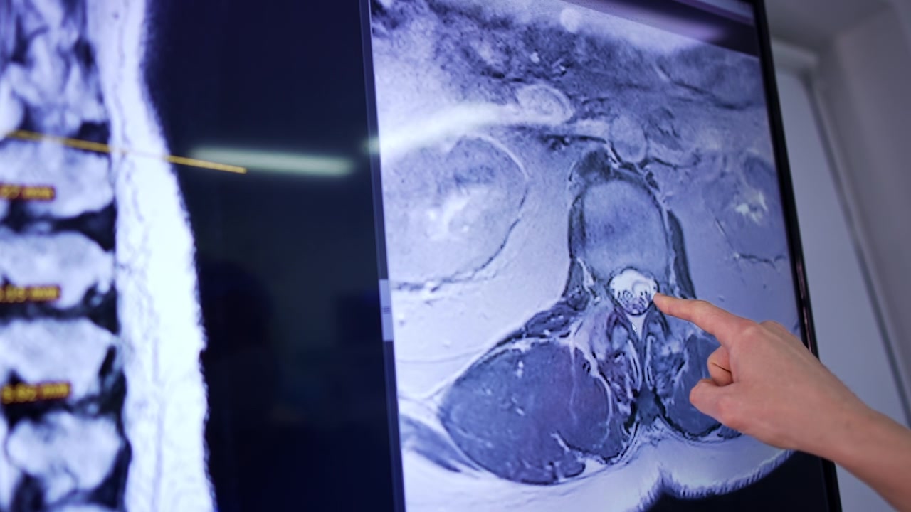 Mano che indica una scansione MRI dettagliata della colonna vertebrale umana su un monitor medico.