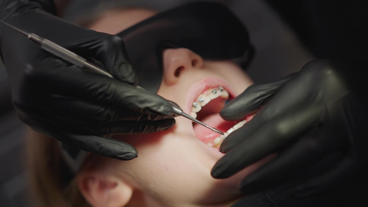 Primo piano di una giovane donna sdraiata con l'apparecchio sui denti mentre un ortodontista che indossa guanti neri usa strumenti dentali per regolare staffe e fili metallici. La scena è ambientata in un ambiente clinico scarsamente illuminato.