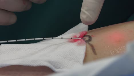 essence of the method is as follows: the laser penetrates into the vein and closes it, using laser energy.