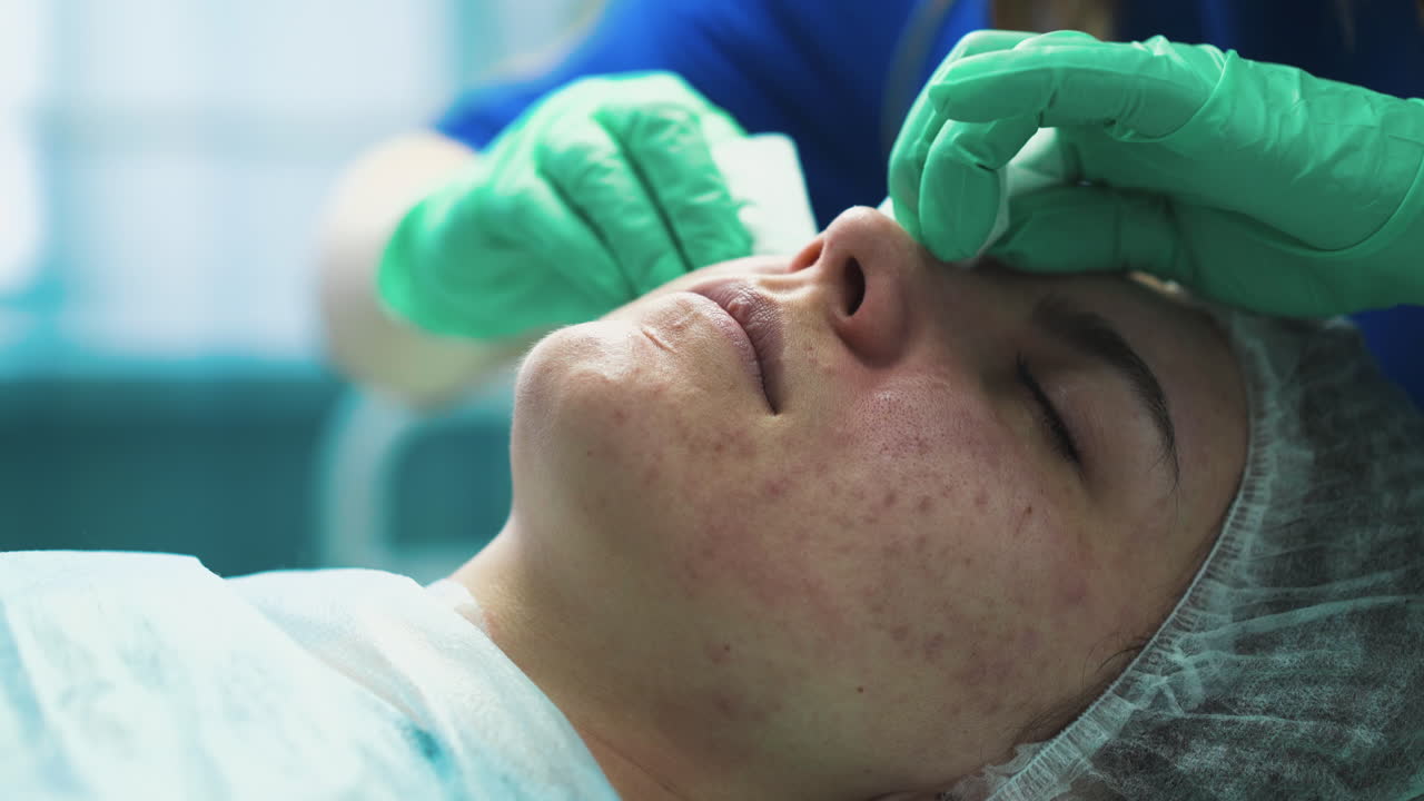 un cosmetologo con i guanti fa spuntare i brufoli sul viso di una giovane donna