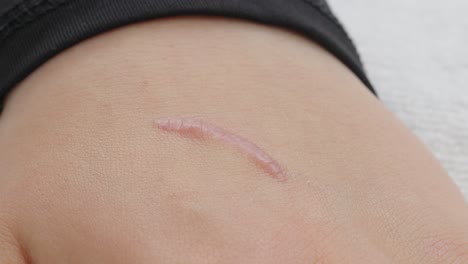 skin scar inpection on hand.