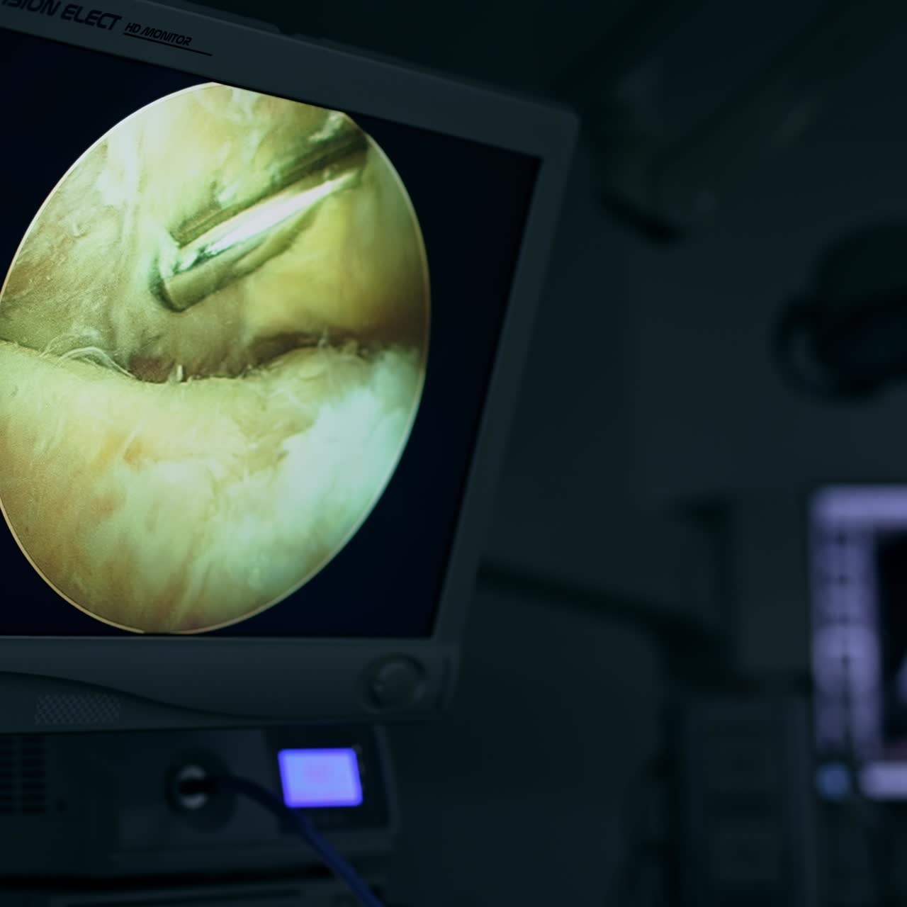 Monitor working in the dark surgery room showing the movement of tool at operation. Laparoscopy procedure at modern clinics