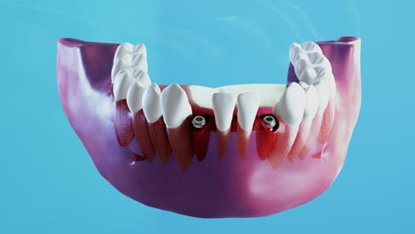 ceramic dental implantation process