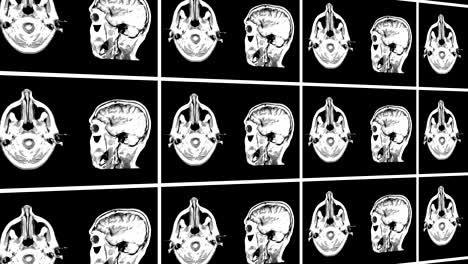 brain top and lateral cut mrt scan