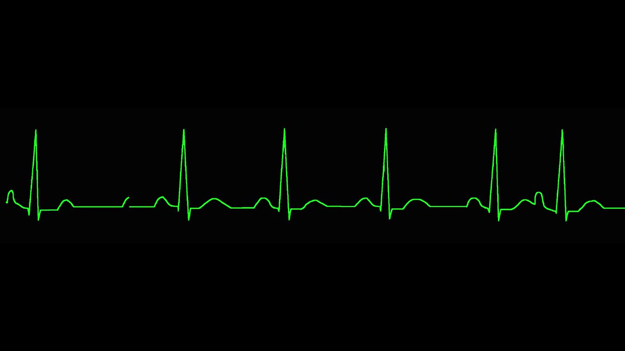 el ecograma muestra una contracción auricular prematura (apc)