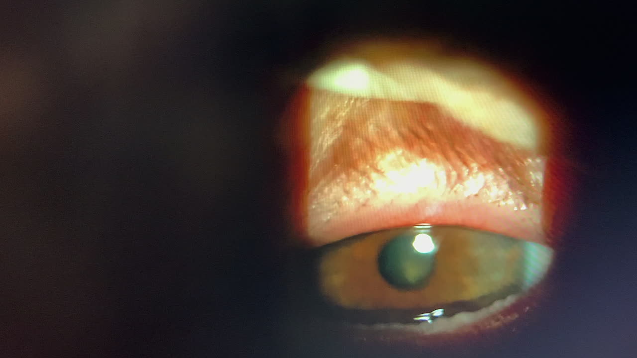 의학적 범위: 환자의 눈에서 meibomian 기름 질을 표현합니다.