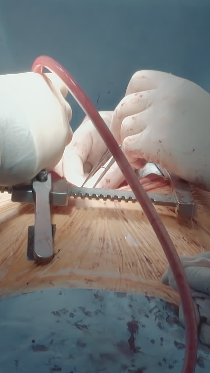 el cirujano utiliza tubos torácicos para operar. el equipo quirúrgico se prepara para cerrar la incisión utilizando una herramienta para drenar líquido y aire de la cavidad torácica en la sala de operaciones.