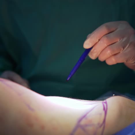 abdominal preparation before liposuction. doctor marking lines on a patient's belly during operation. cosmetic surgery