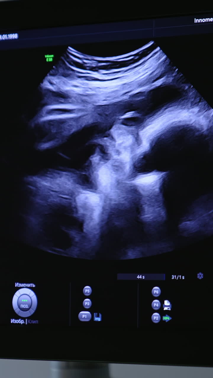 Immagine ecografica di un feto sullo schermo nero dell'apparecchiatura. Il bambino viene osservato in diverse posizioni. Primo piano. Video verticale.