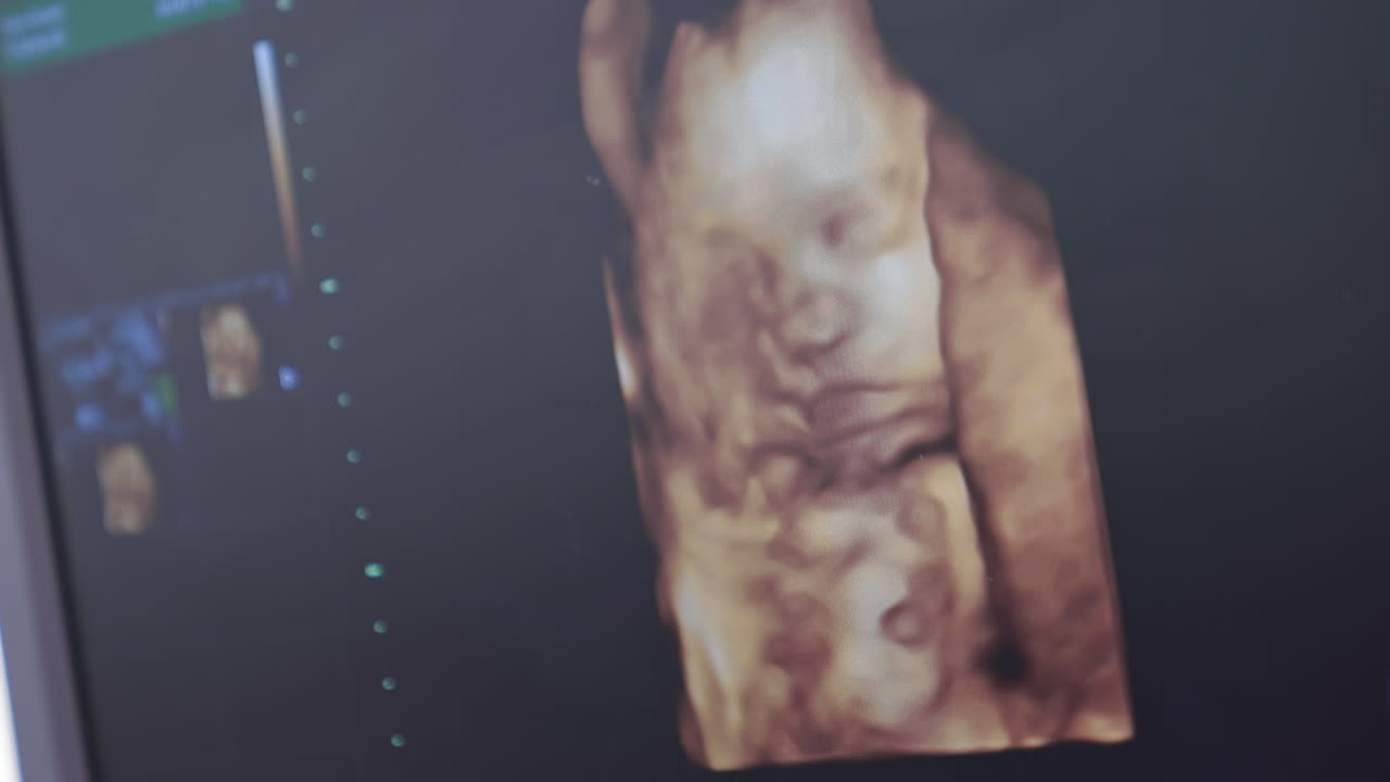 Human embryo in color on the screen during sonography. Ultrasound of ...