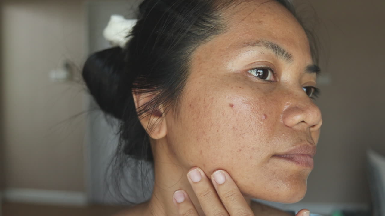 Primo piano di una donna che esamina l'acne e la condizione della pelle, girando la testa per controllare entrambe le guance e toccandosi delicatamente il mento. Luce naturale, texture della pelle reale, concetto di cura della pelle e dermatologia