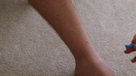 man attempting to remove stubborn ticks lodges into a persons leg