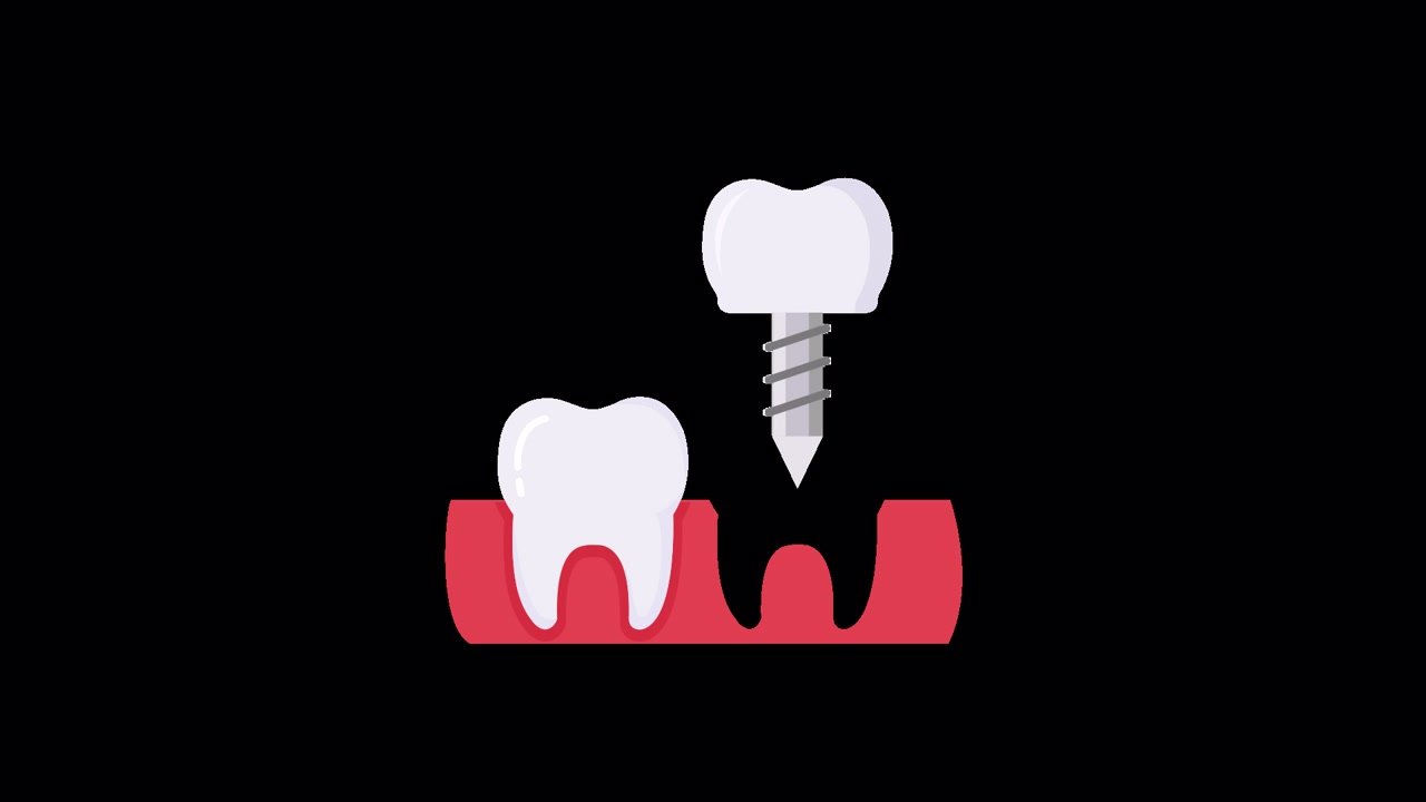 Animated Illustration of a Dental Implant and Natural Tooth