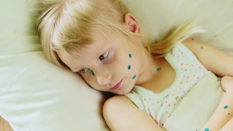 Girl-ill-with-chickenpox-1