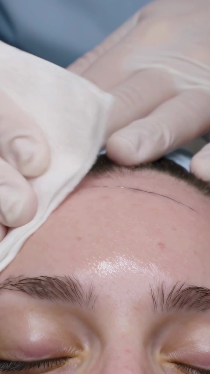 Video verticale: Tecnico guantato che posiziona una garza e si asciuga la fronte in clinica, indossando un top blu ed esponendo una macchia e un segno.