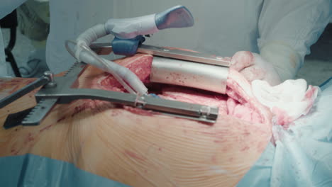 heart stabilizing device on chest. surgeon uses equipment to keep heart still while doing bypass surgery. process of coronary artery bypass graft