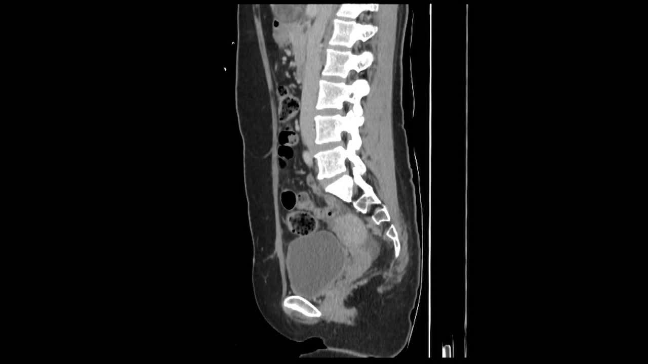 Explore the role of CT scans in diagnosing appendicitis and gallstones.