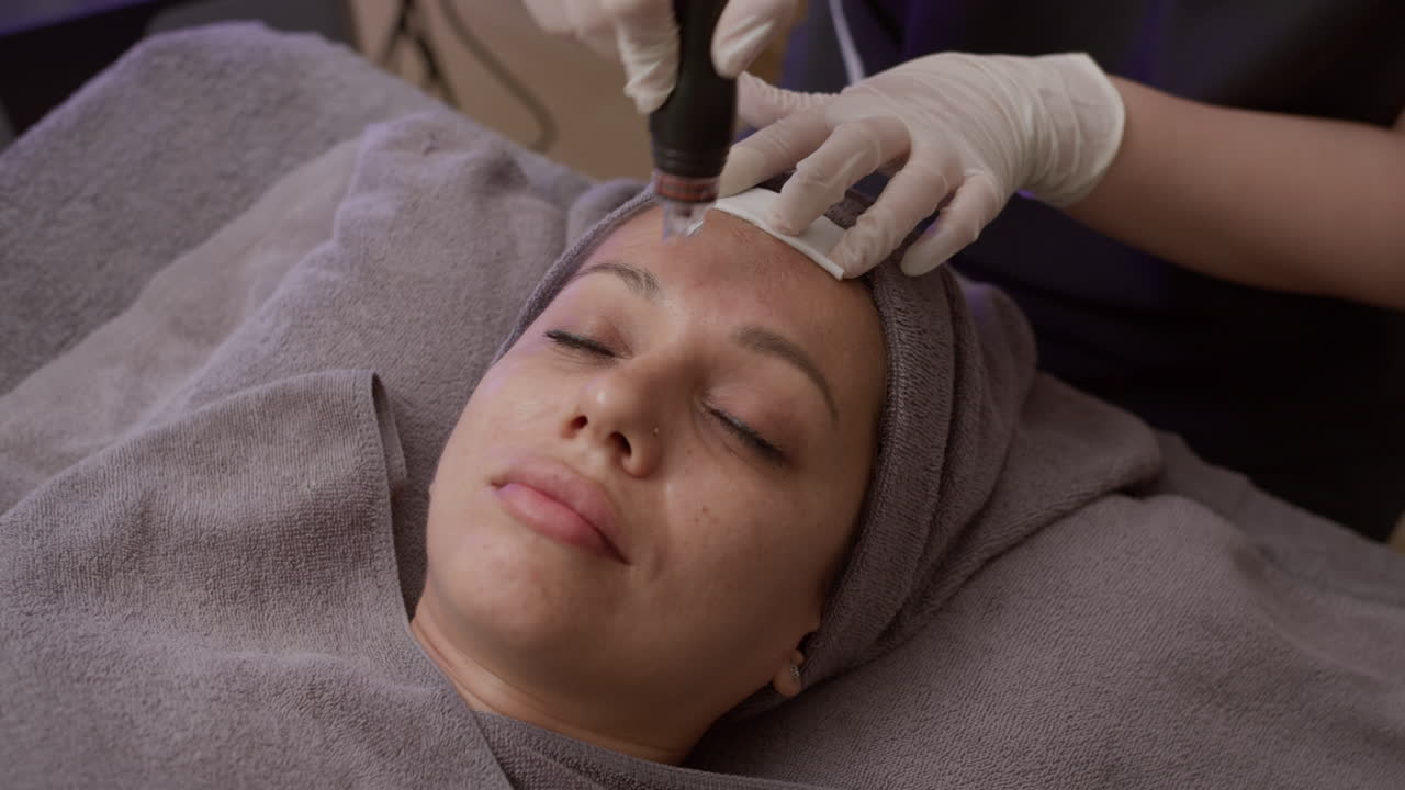 Caucasian Woman Getting Anti-wrinkle Treatment during Microneedling Procedure