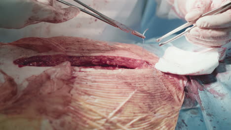 surgeon hands close skin facial layer. skilled medic use absorbable sutures closing chest incision after successful coronary artery bypass surgery closeup