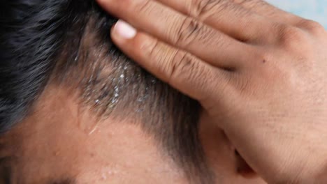 scalp condition with dandruff and treatment