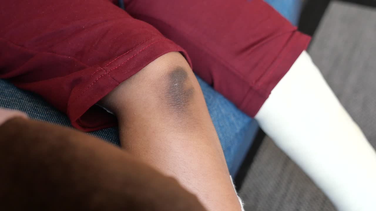 mancha oscura en el codo del niño