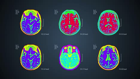 escáner cerebral. seis vistas en una pantalla. 4k médico de fondo colorido