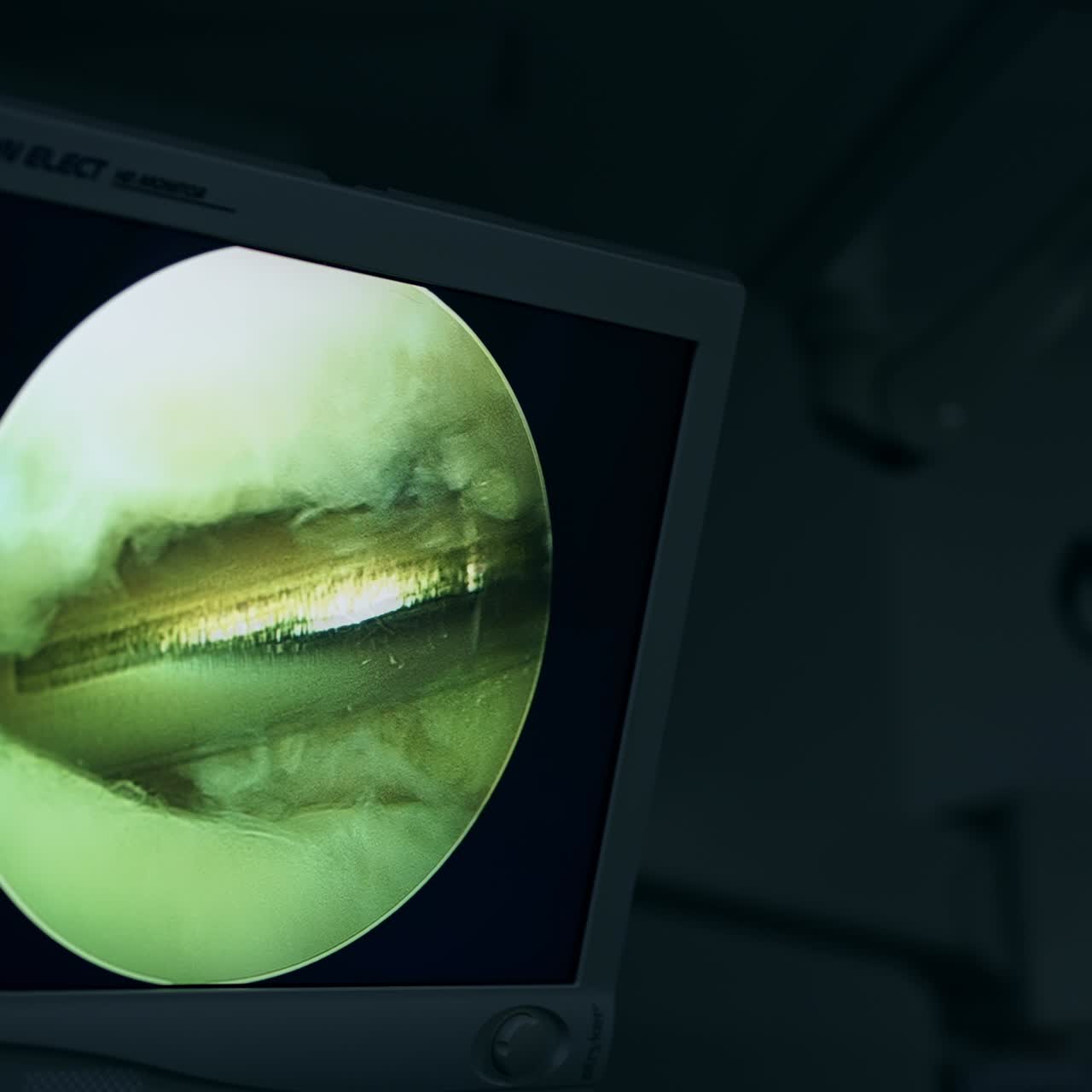 Metal tool with the help of which the operation is conducted. Monitor working in the dark surgery room during procedure