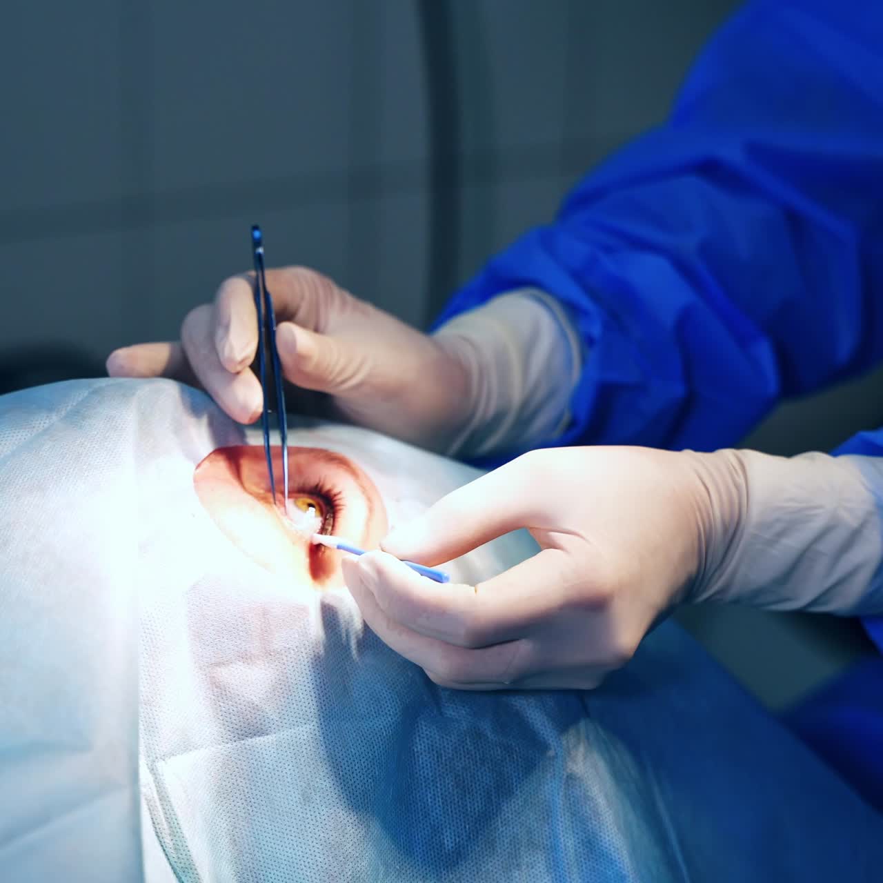 cataract surgery close up view