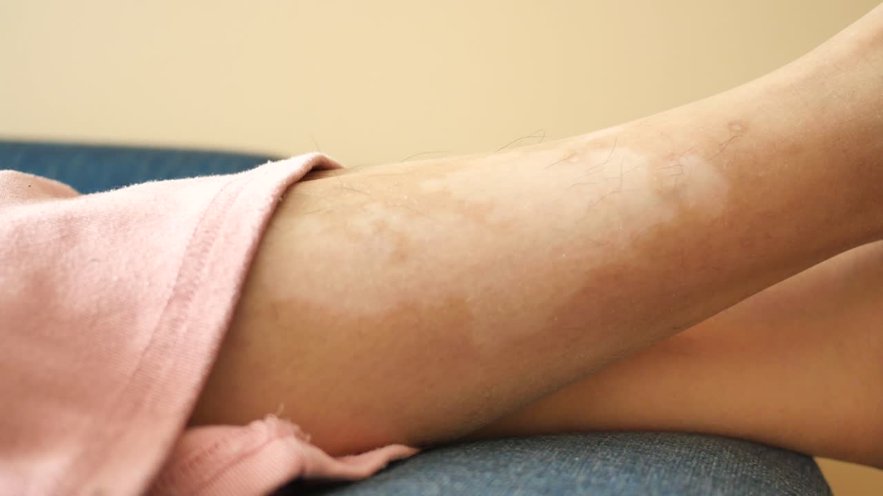 Vitiligo or similar skin condition on a leg