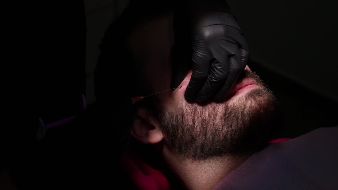 Uomo sottoposto a procedura estetica di lifting con fili sul viso.