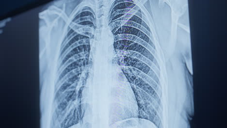 chest x-ray on digital screen. closeup