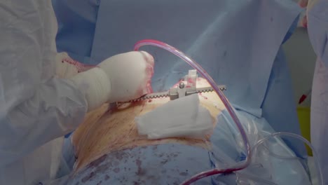 drainage of blood flow during the operation 1