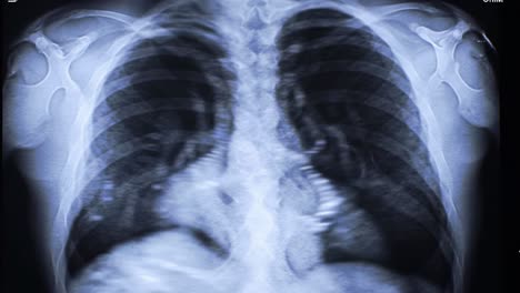 this recording presents a chest x-ray displaying lung anatomy and possible issues. the image indicates areas for professional analysis of respiratory health and concerns.