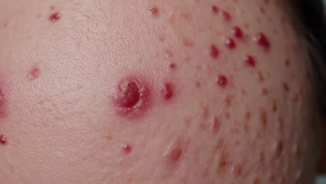 close-up of skin with severe acne blemishes