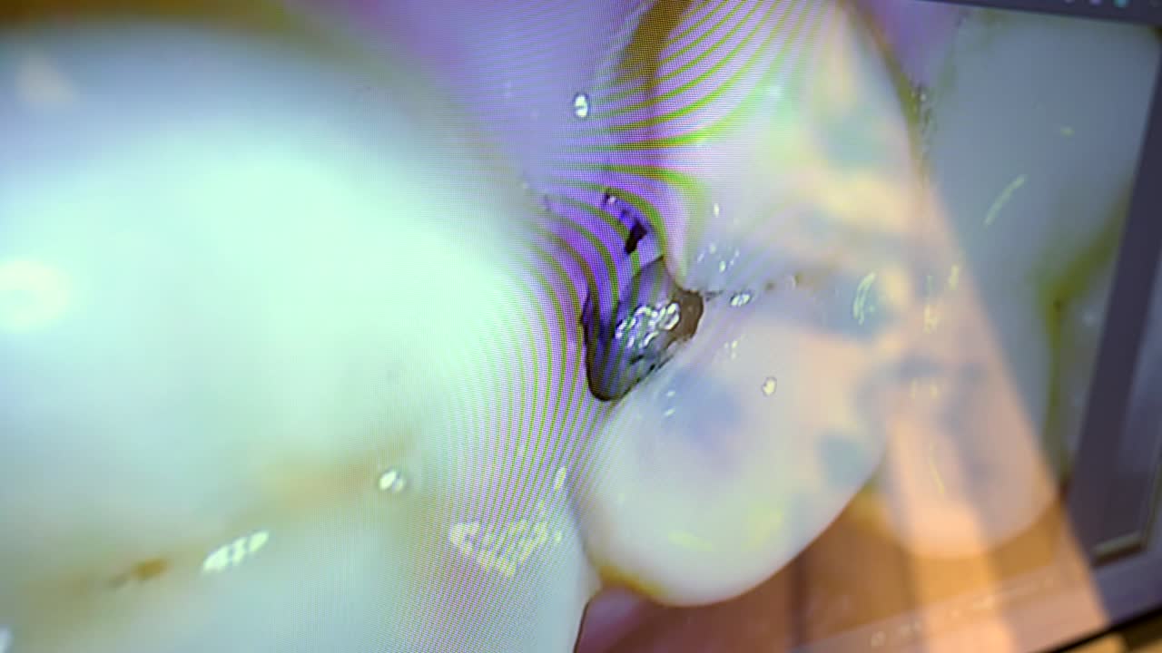 Dental Cavity Filling