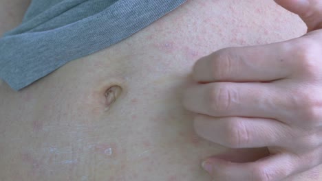 una reacción alérgica de color rojo pálido se vierte en el estómago. hay una pequeña costra cerca del ombligo. rascan la piel con uñas en el lado izquierdo del abdomen. enfermedades virales. primer plano