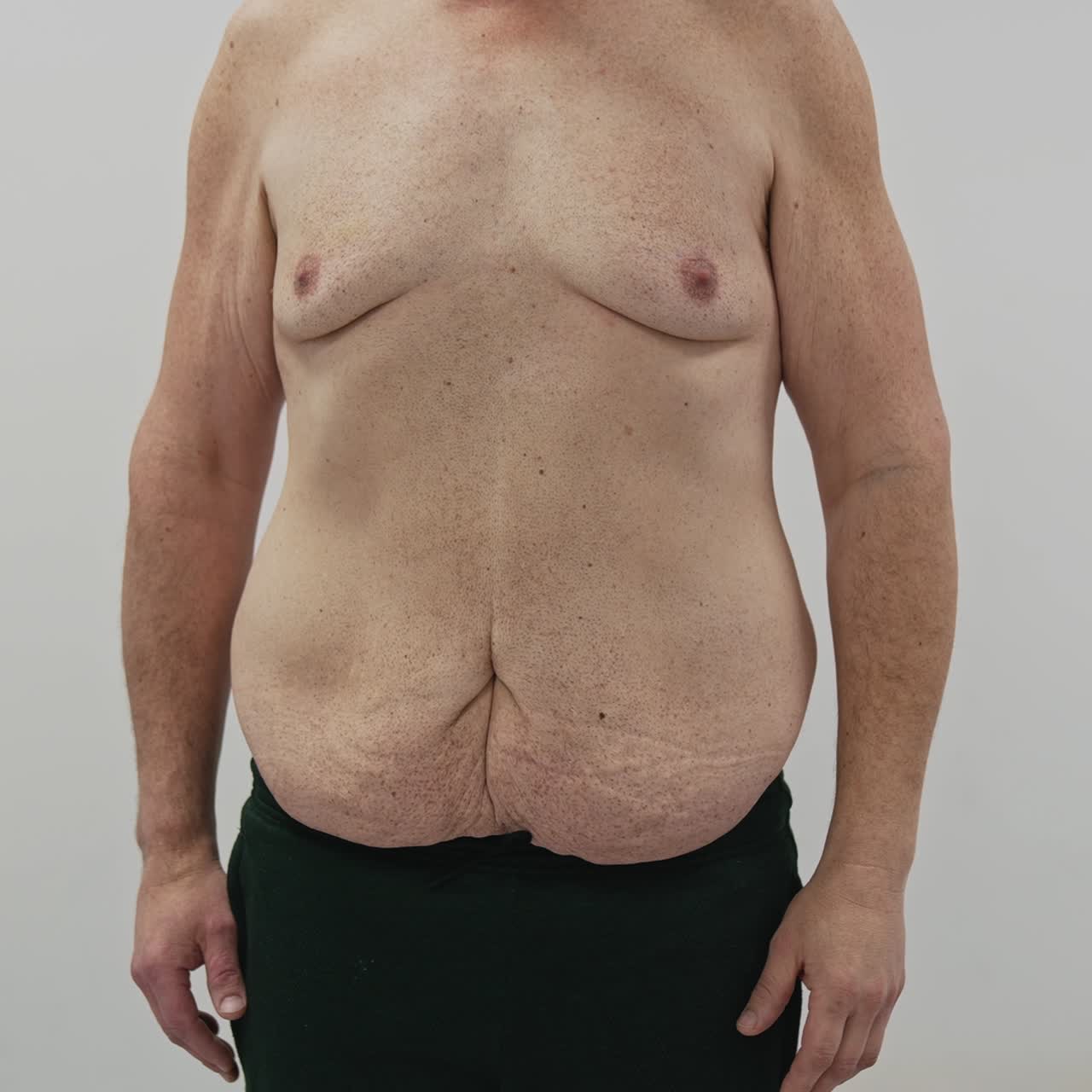 Man's body after weight loss. Male patient showing his unhealthy body with problem parts on a belly on white background in clinic. Body lifting