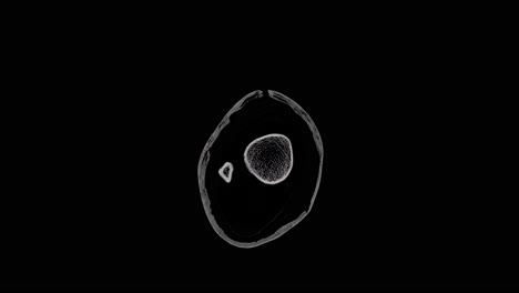 MRT-Scan-Eines-Fußes-Mit-Mehreren-Kleinen-Frakturen,-Scan-Von-Oben-Nach-Unten