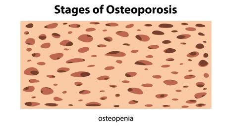 visual representation of bone density changes