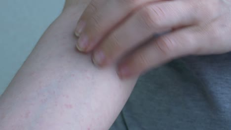 en el intervalo desde el codo hasta la mano, el primer plano muestra una pequeña inflamación rosa claro de la piel. la piel con picazón está rascada con uñas. enfermedades virales. primer plano
