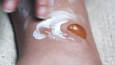 closeup of medical ointment applied to swollen blisters for pain management treatment