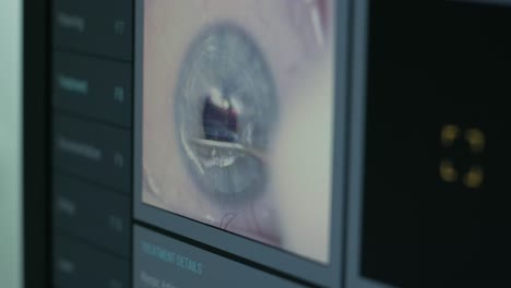 ophthalmic surgery. view on the screen of medical monitor in operating room. lasik