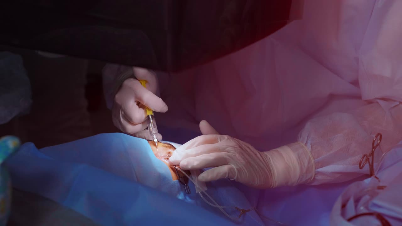 cirugía ocular. un paciente y un cirujano en la sala de operaciones durante una cirugía oftalmológica. paciente bajo microscopio quirúrgico. corrección de la visión