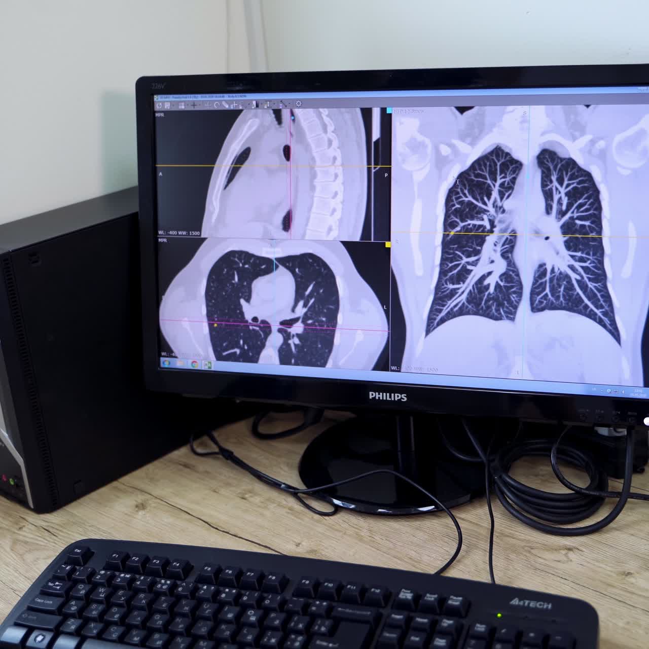 Medic looking at the screen with MRI image of lungs. Unrecognized female doctor working on the analysis of scans